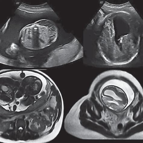 Case 2 2d And 3d Fetal Brain Ultrasound Showing Marked Ventricular