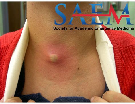 Saem Clinical Image Series A Recurring Neck Mass