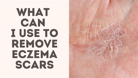 What Can I Use To Remove Eczema Scars Treat Your Scars