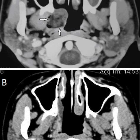 A Axial Section Of A Contrast Enhanced Ct Scan Shows The Hypodense