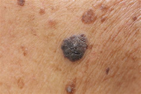 Mole Types And Treatments Us Dermatology Partners