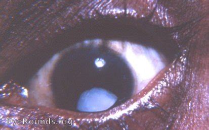 Subluxated Cataract Eyerounds Org Online Ophthalmic Atlas