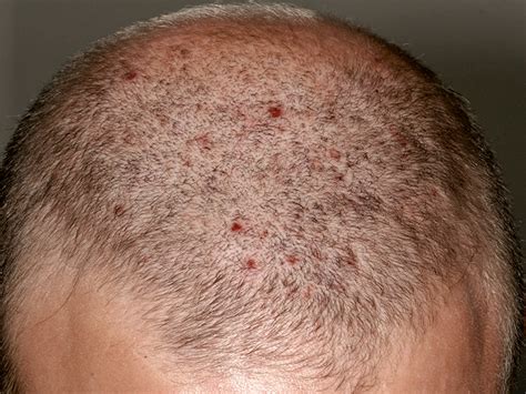 Bumps On The Scalp Causes Symptoms And Treatments