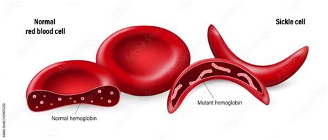 Sickle Cell Disease Normal Red Blood Cells And Sickled Red Blood Cells