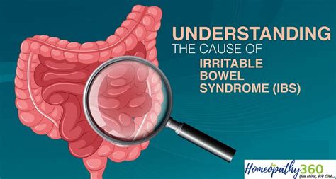 Ibs Irritable Bowel Syndrome Symptoms Causes Diagnosis And Treatment With Homeopathy