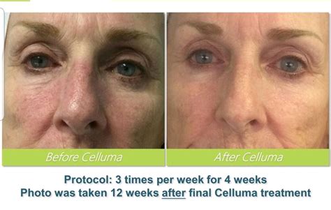 Celluma Led Light Therapy For Skin Soliderma
