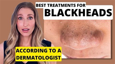 Blackheads Dermatologist Shares Best Treatments To Remove Them With