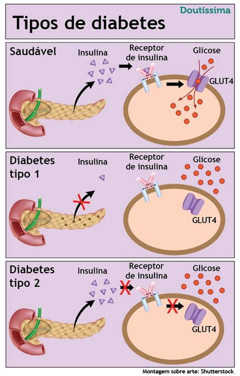 Os tipos de diabetes e como tratá los