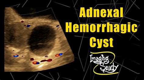 Adnexal Hemorrhagic Cyst Ultrasound Case Youtube