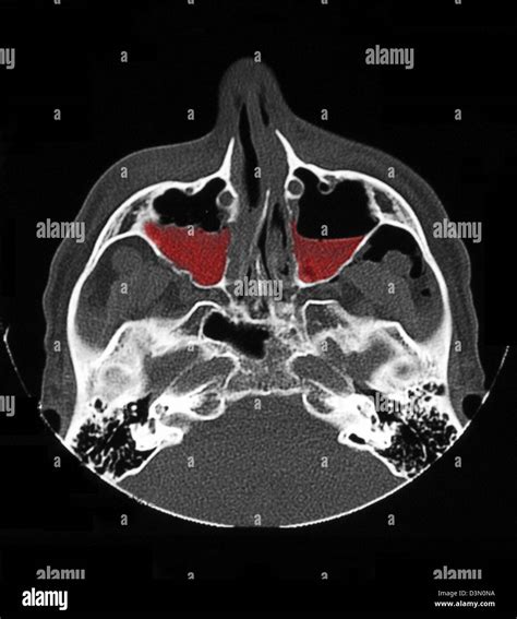 CT scan image montrant les fractures du sinus maxillaire bilatéral
