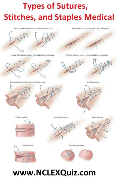 Types Of Sutures Stitches And Staples Medical Nclex Quiz