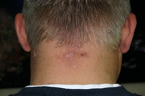 Folliculitis On Head Pictures 54 Photos And Images