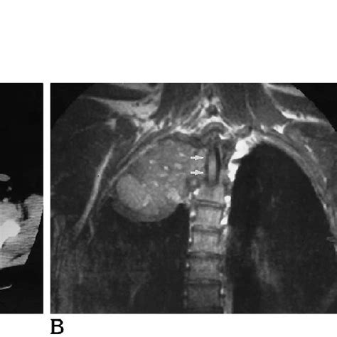 A Axial Ct Scan After Contrast Administration Aneurysmal Bone Cyst