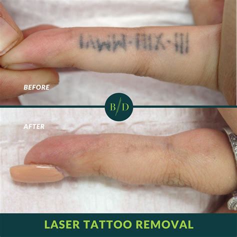 Update More Than 80 Tattoo Laser Removal Before And After Incdgdbentre