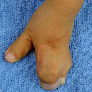 Syndactyly Conjoined Fingers Or Toes And Corrective Surgery