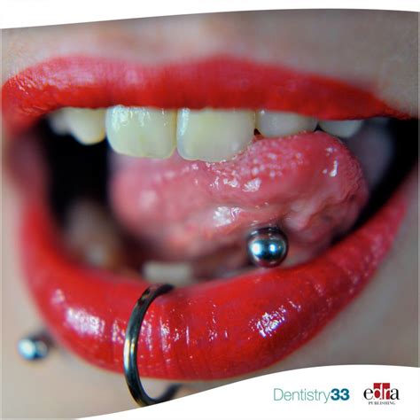 effect of lingual piercing on periodontal and peri implant health dentistry33