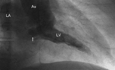 Figure 3 From Perforated Mitral Valve Aneurysm Associated With Libman