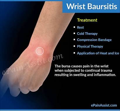 Wrist Bursitis Causes Epainassist Bursa Fluid Inflammation