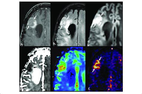 Perfusion Weighted Imaging Pwi Brain Mri Of A Old With A Diagnosis