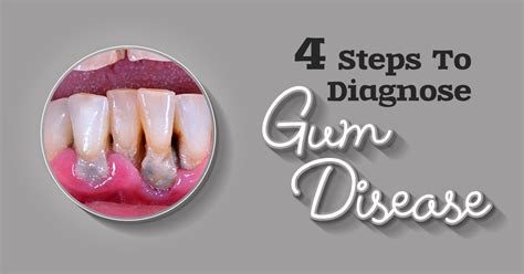 How To Stop Gum Disease In 4 Easy Steps Captions Lovers