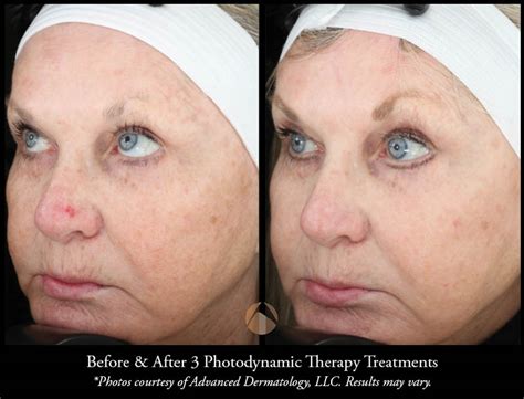 Blue Light Photodynamic Therapy For Actinic Keratosis Shelly Lighting