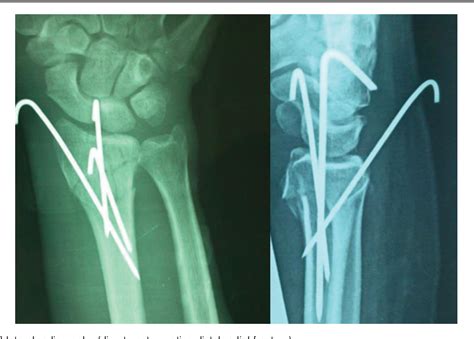 Figure 2 From Treatment Of Distal Radius Fractures With Percutaneous