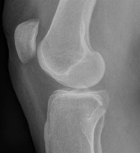 The Knee Resource Patellar Dislocation And Subluxation