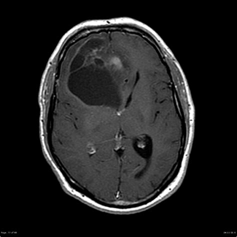 Brain cancer is common in older cats, accounting for secondary tumors carry a guarded prognosis as metastasis (spread) within the body is present at the time of diagnosis indicating that the cancer is. Diffuse astrocytoma IDH-mutant (gemistocytic) | Image ...