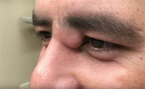 Dr Pimple Popper Removes Massive Cyst From A Mans Eye Area Allure