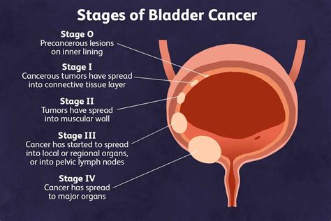 Bladder Cancer Symptoms Stages Treatments And Facts