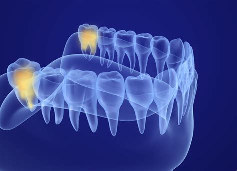 Get Answers To Your Most Commonly Asked Questions About Wisdom Teeth