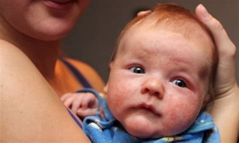 Atopic Dermatitis In Babies What You Need To Know Blog Scrolls