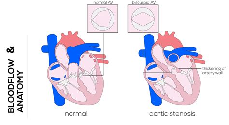 Aortic Stenosis Congenital Aortic Valve Stenosis And Rheumatic Aortic