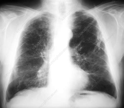 Check spelling or type a new query. Asbestosis, X-ray - Stock Image - M108/0628 - Science Photo Library