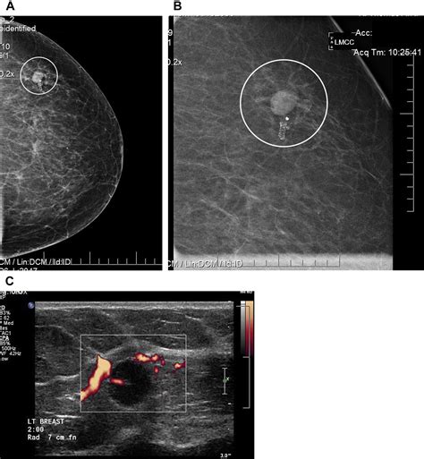 Extranodal Lymphoma Of The Breast Radiologic Clinics