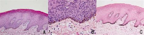Histopathological Examination Showed A Mild Acanthosis Basal