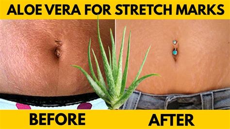 Ways To Use Aloe Vera To Get Rid Of Stretch Marks Youtube