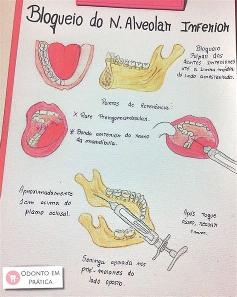 Práctica Dental En Instagram “ Técnica Anestésica Bloqueo Del Nervio