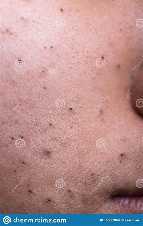 Ugly Pimples Blackheads On Cheek Face Of Teenager Stock Image Image