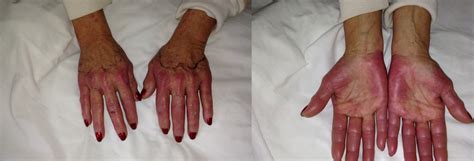 Cureus Hand Foot Syndrome Secondary To Low Dose Docetaxel In A Breast