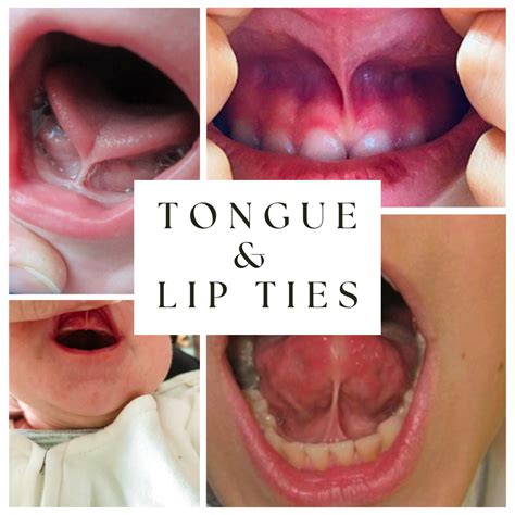 Tongue And Lip Ties Dr Hal Stewart