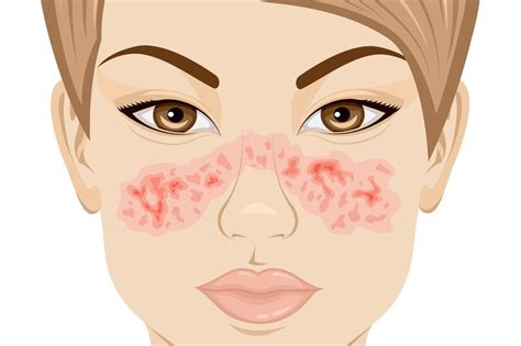 12 Lupus Symptoms To Know What Does A Lupus Rash Look Like