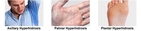 Hyperhidrosis Face And Scalp Cojpfi