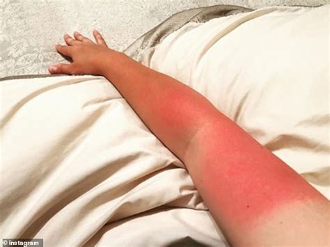 Baked Brits Share Snaps Of Their Disastrous Sunburn Following The