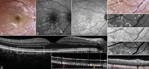 Multimodal Imaging Features Of Congenital Grouped Albinotic Spots A