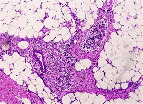 Premium Photo Photomicrograph Of Granulomatous Tissue Histology