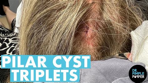 A Head Full Of Pilar Cysts Dr Pimple Popper Removes Massive Cysts From