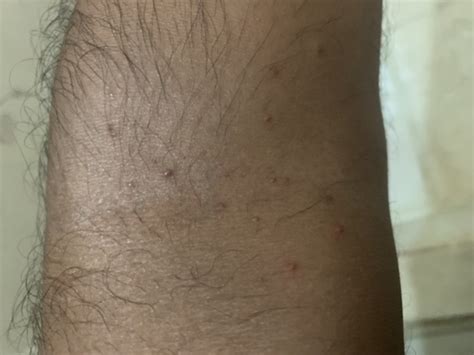 Small Red Spots On Both Hands Not Itchy Pics Included