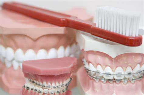 the ultimate guide to adult braces louisville orthodontists