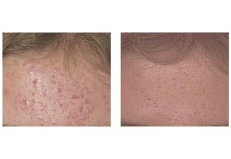 Laser Acne Treatment Blu U Lasers San Diego Ca